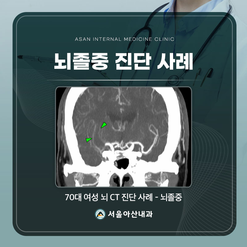 뇌졸중 진단 사례