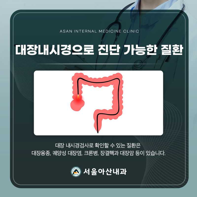 용종 제거 효과